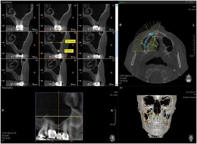 Sinus Augmentation with Biomimetic Nanostructured Matrix: Tomographic, Radiological, Histological and Histomorphometrical Results after 6 Months in Humans